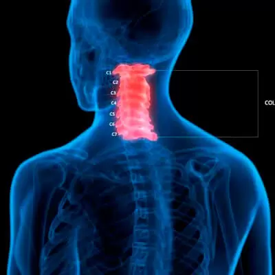 Dor Cervical